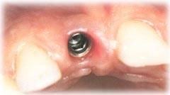 Implantate Zahnarzt Dr. Rosian Steiermark